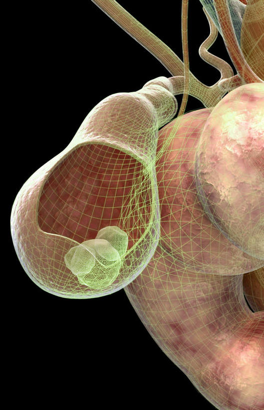 内脏,动脉,静脉,胆囊,无人,竖图,插画,室内,特写,白天,正面,数码,科技,静物,阴影,黑色背景,网络,医学,高光,几何,计算机图形,合成,图画,画,模型,人体,电脑合成图,数码合成图,生物学,器官,漫画,生理学,写实,具体,具象,胆囊结石,彩图