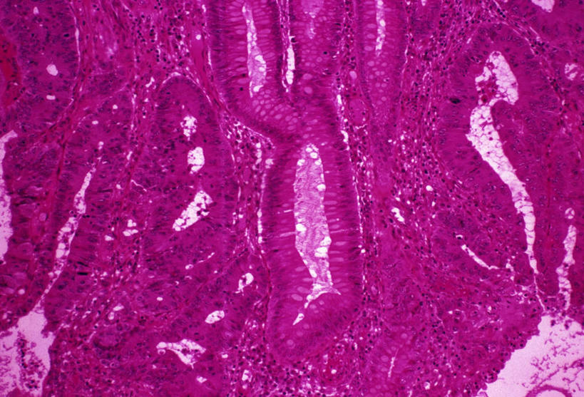 无人,横图,插画,室内,白天,正面,数码,科技,静物,阴影,网络,医学,细胞,高光,几何,计算机图形,合成,图画,画,红色,人体,电脑合成图,数码合成图,生物学,漫画,癌症,癌细胞,生理学,写实,具体,具象,结肠癌,彩图